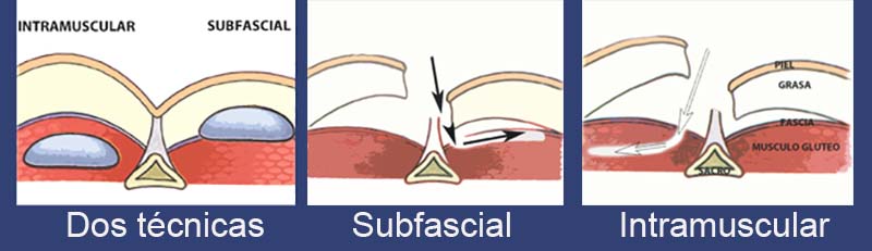 esquemas planos de implantes gluteos