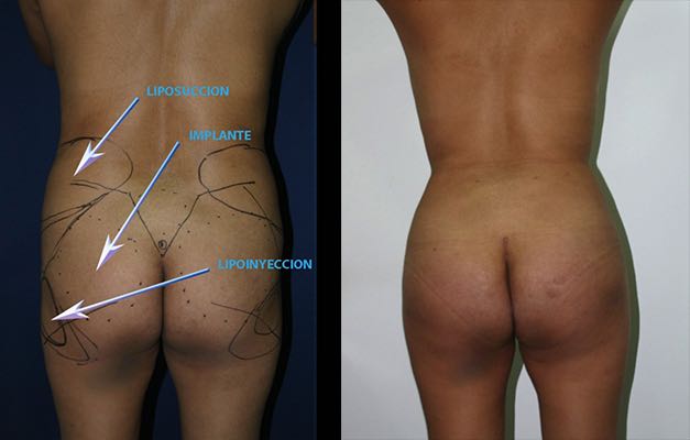 fotos antes y despues implantes gluteos