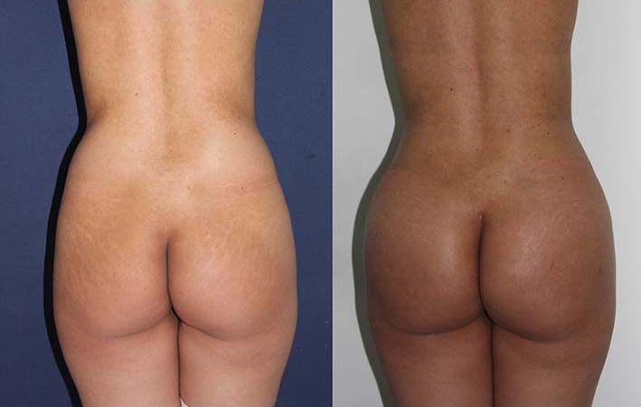 fotos desde atras implantes gluteos