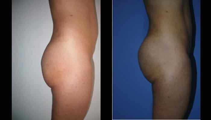 fotos antes y despues implantes gluteos