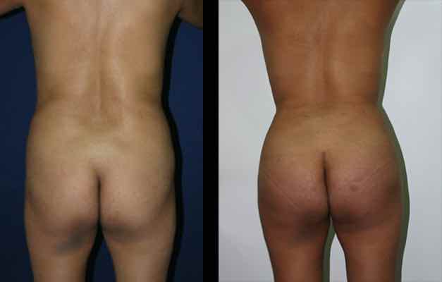 fotos antes y despues implantes gluteos