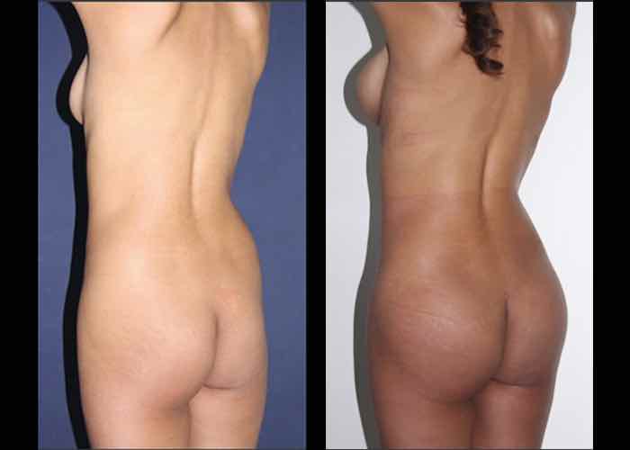 fotos antes y despues implantes gluteos