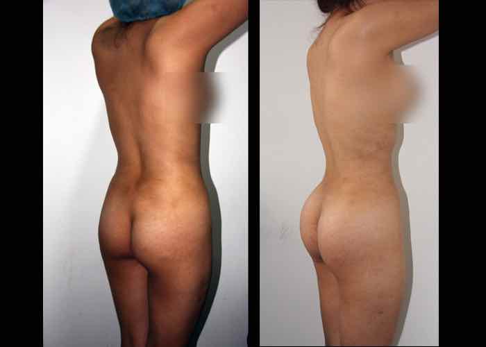 fotos antes y despues implantes gluteos