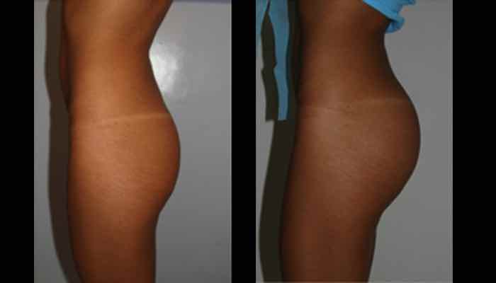 fotos antes y despues implantes gluteos