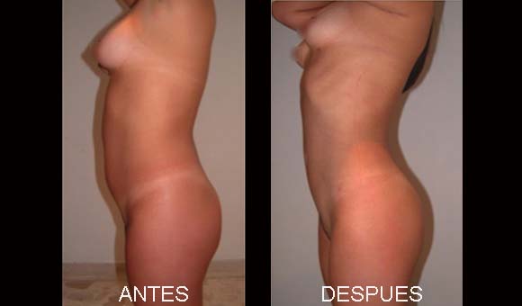 FOTOS ANTES DESPUES LIPO2