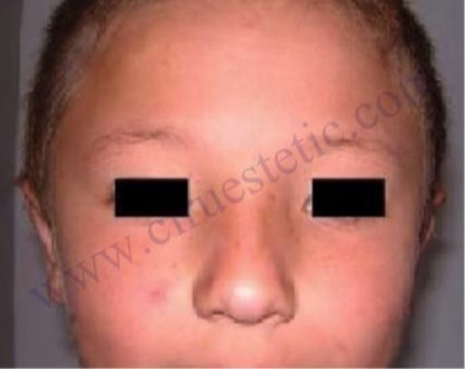 FOTO OTOPLASTIA FRONTAL DESPUES