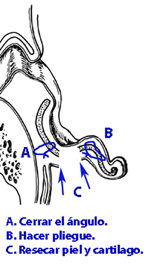 esquema cirugia