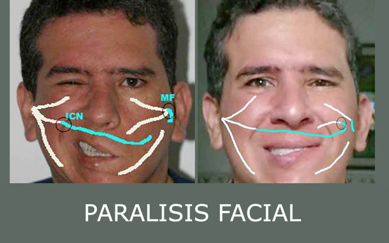 fotos de paciente con paralisis facial corregida