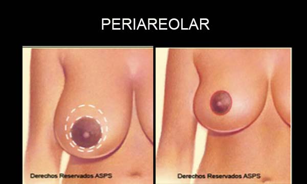 esquema cicatriz periareolar