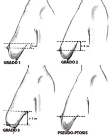 esquema seno caido