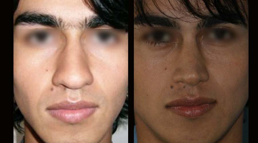 Fotos rinoplastia antes y despues 12