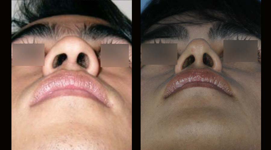 Fotos rinoplastia antes y despues 14