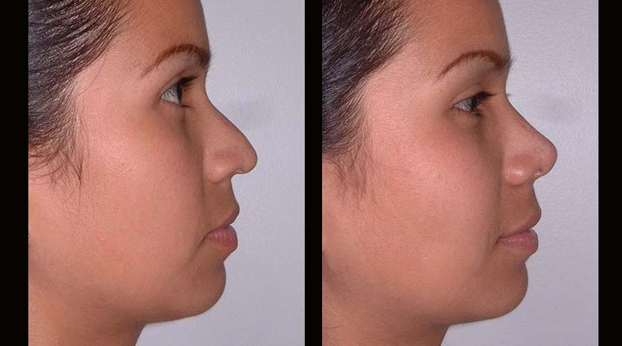 Fotos rinoplastia antes y despues 16