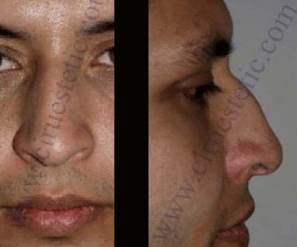 Fotos rinoplastia antes y despues 25