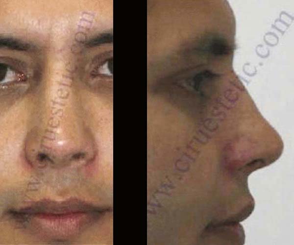 Fotos rinoplastia antes y despues 26