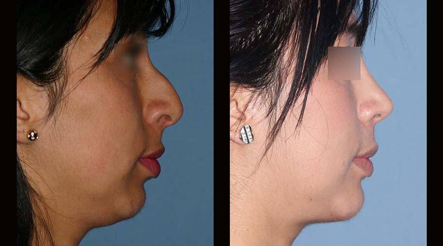 Fotos rinoplastia mas mentoplastia antes y despues 1