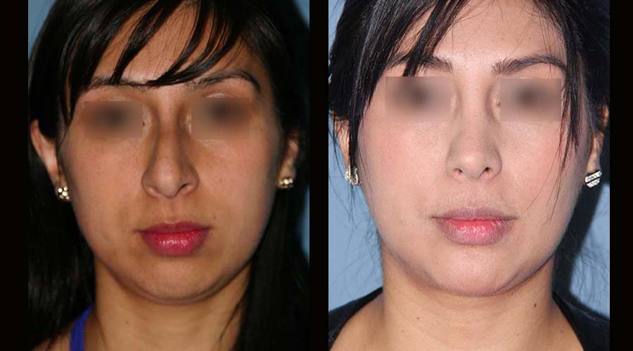 Fotos rinoplastia mas mentoplastia antes y despues 2