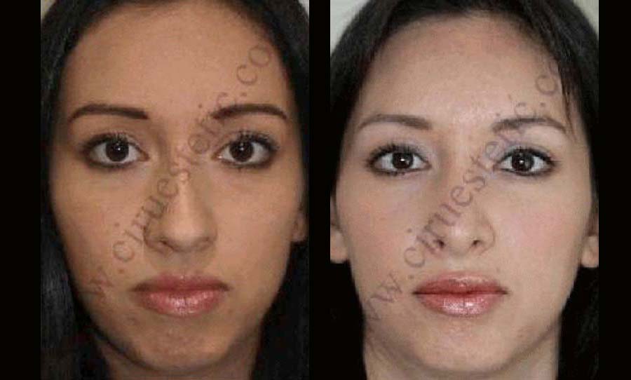 Fotos rinoplastia mas mentoplastia antes y despues 3