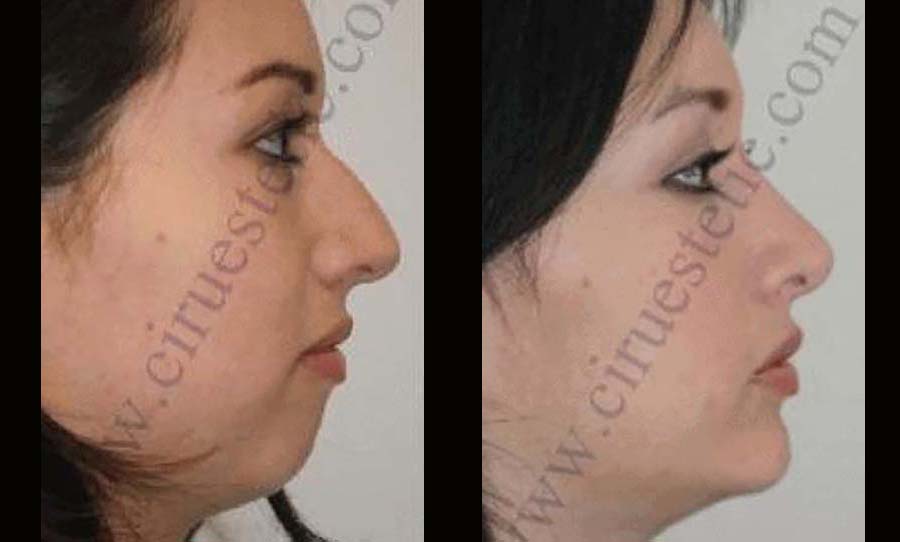 Fotos rinoplastia mas mentoplastia antes y despues 4