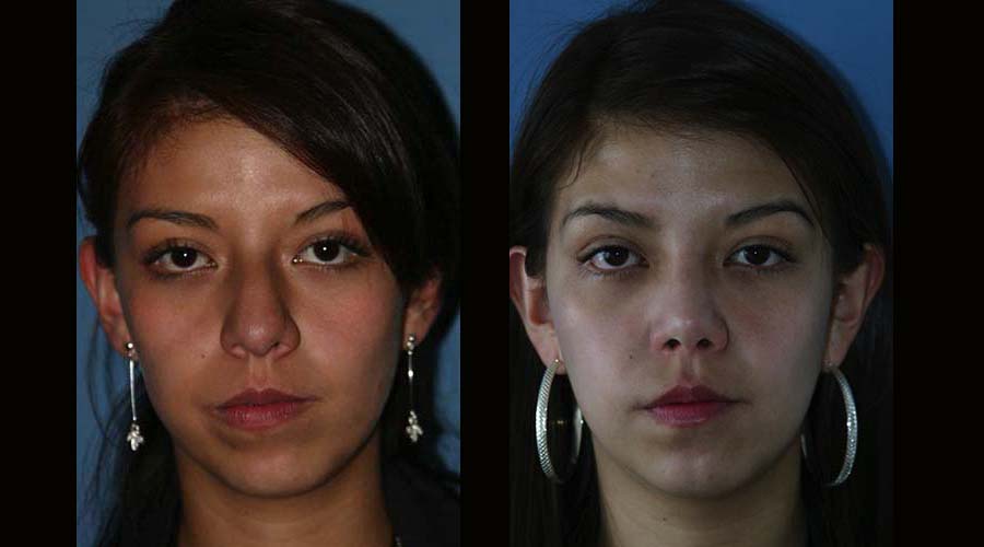 Fotos rinoplastia antes y despues 6