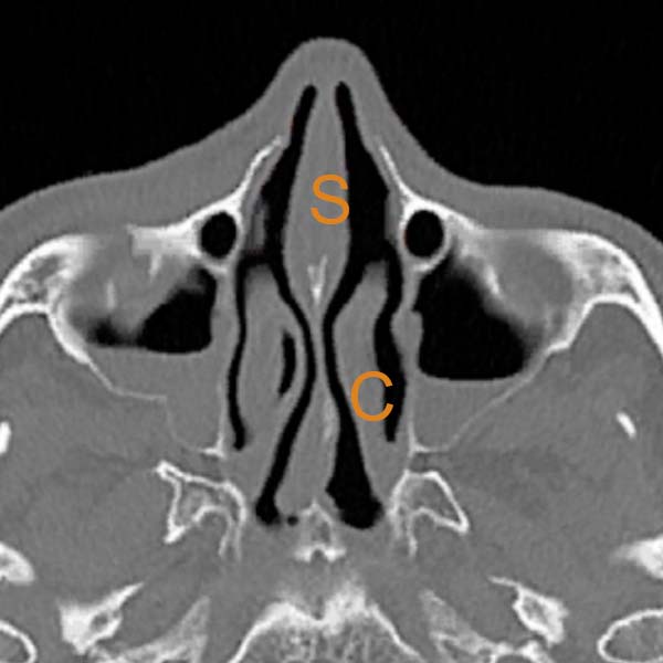 foto tac septum axial