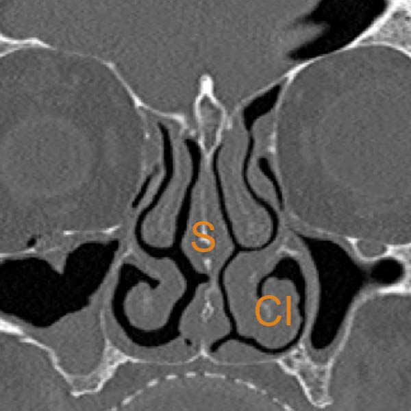 foto de tac coronal